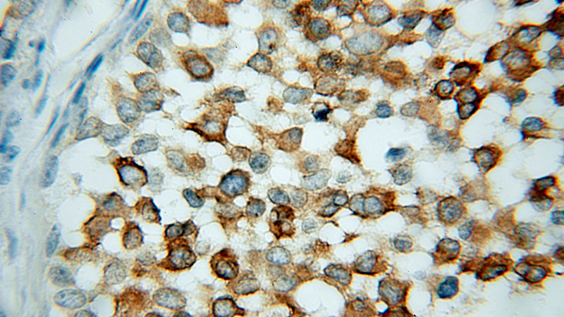 Immunohistochemical of paraffin-embedded human breast cancer using Catalog No:107835(AGR2 antibody) at dilution of 1:100 (under 10x lens)