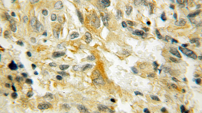 Immunohistochemical of paraffin-embedded human gliomas using Catalog No:114027(PMP2 antibody) at dilution of 1:100 (under 10x lens)