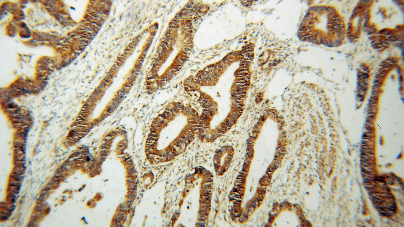 Immunohistochemical of paraffin-embedded human colon cancer using Catalog No:109330(CKMT1A antibody) at dilution of 1:50 (under 10x lens)
