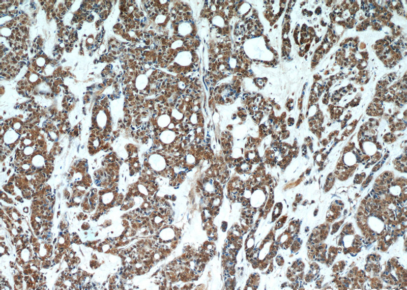 Immunohistochemical of paraffin-embedded human cervical cancer using Catalog No:107237(DDB1 antibody) at dilution of 1:50 (under 10x lens)