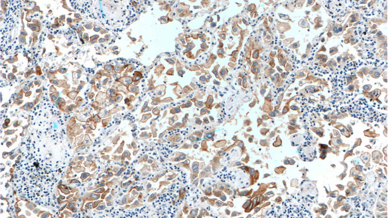Immunohistochemistry of paraffin-embedded human lung cancer tissue slide using Catalog No:111139(GPRC5A,RAI3 Antibody) at dilution of 1:200 (under 10x lens).