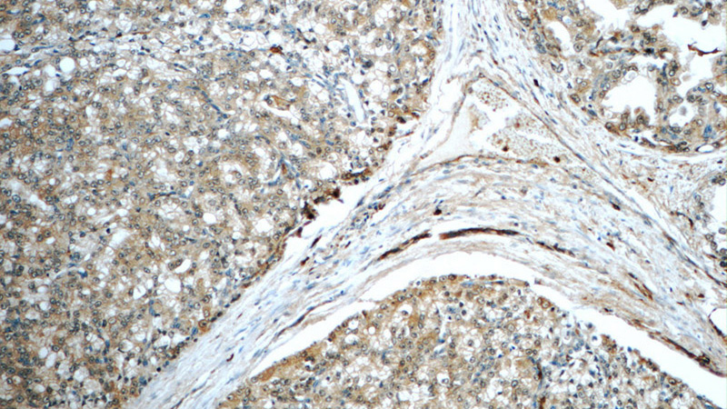Immunohistochemistry of paraffin-embedded human prostate cancer tissue slide using Catalog No:109457(COPE Antibody) at dilution of 1:50 (under 10x lens)