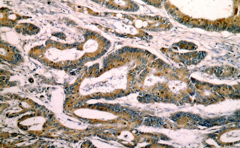 Immunohistochemical of paraffin-embedded human colon cancer using Catalog No:112537(MGAT3 antibody) at dilution of 1:50 (under 10x lens)