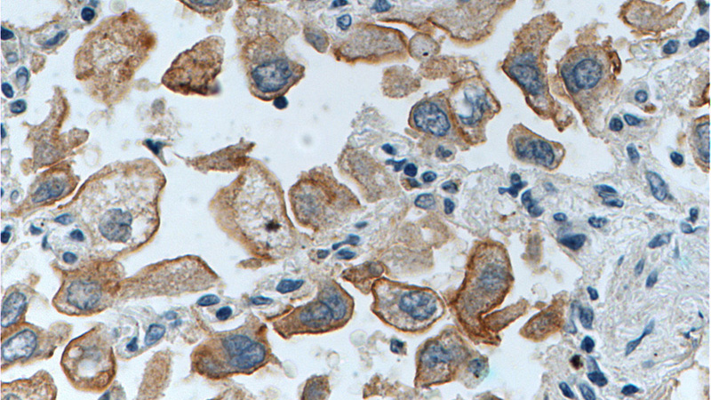 Immunohistochemistry of paraffin-embedded human lung cancer tissue slide using Catalog No:111139(GPRC5A,RAI3 Antibody) at dilution of 1:200 (under 40x lens).