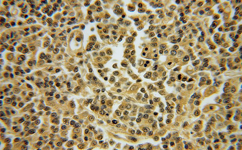 Immunohistochemical of paraffin-embedded human lymphoma using Catalog No:116064(TNFAIP8L2 antibody) at dilution of 1:50 (under 40x lens)