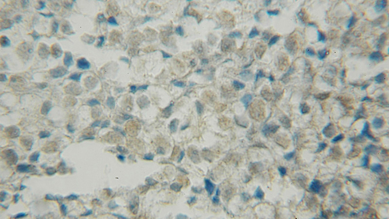 Immunohistochemical of paraffin-embedded human ovary tumor using Catalog No:117244(BRSK1 antibody) at dilution of 1:50 (under 10x lens)