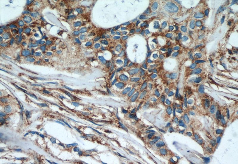 Immunohistochemical of paraffin-embedded human breast cancer using Catalog No:112563(SLC16A3 antibody) at dilution of 1:50 (under 40x lens)