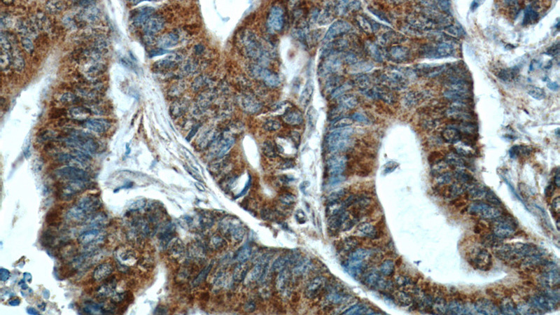 Immunohistochemical of paraffin-embedded human colon cancer using Catalog No:111279(HCFC1 antibody) at dilution of 1:50 (under 40x lens)