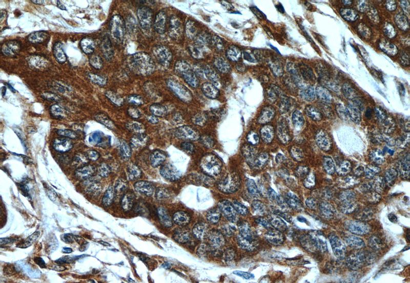 Immunohistochemistry of paraffin-embedded human skin cancer tissue slide using Catalog No:112702(MMP21 Antibody) at dilution of 1:50 (under 40x lens)