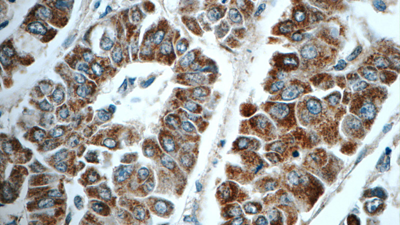 Immunohistochemistry of paraffin-embedded human liver cancer tissue slide using Catalog No:108679(C1orf56 Antibody) at dilution of 1:50 (under 40x lens)