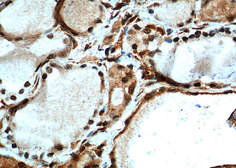 Immunohistochemistry of paraffin-embedded human thyroid cancer tissue slide using Catalog No:112918(MYCN Antibody) at dilution of 1:200 (under 40x lens). heat mediated antigen retrieved with Tris-EDTA buffer(pH9).