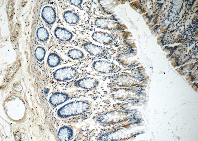 Immunohistochemistry of paraffin-embedded human colon tissue slide using Catalog No:113637(PDS5A Antibody) at dilution of 1:50 (under 10x lens)