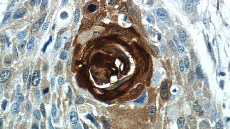 Immunohistochemistry of paraffin-embedded human oesophagus cancer tissue slide using Catalog No:114964(S100A7 Antibody) at dilution of 1:50 (under 40x lens)