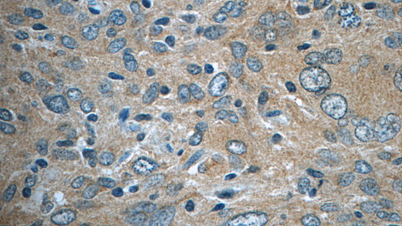 Immunohistochemistry of paraffin-embedded human gliomas tissue slide using Catalog No:109238(CHN1 Antibody) at dilution of 1:50 (under 40x lens)