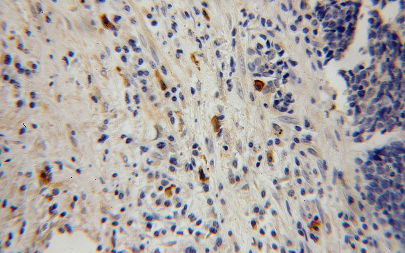 Immunohistochemical of paraffin-embedded human lung cancer using Catalog No:111413(HK3 antibody) at dilution of 1:100 (under 40x lens)