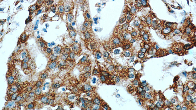 Immunohistochemical of paraffin-embedded human pancreas cancer using Catalog No:113551(P4HA2 antibody) at dilution of 1:50 (under 40x lens)