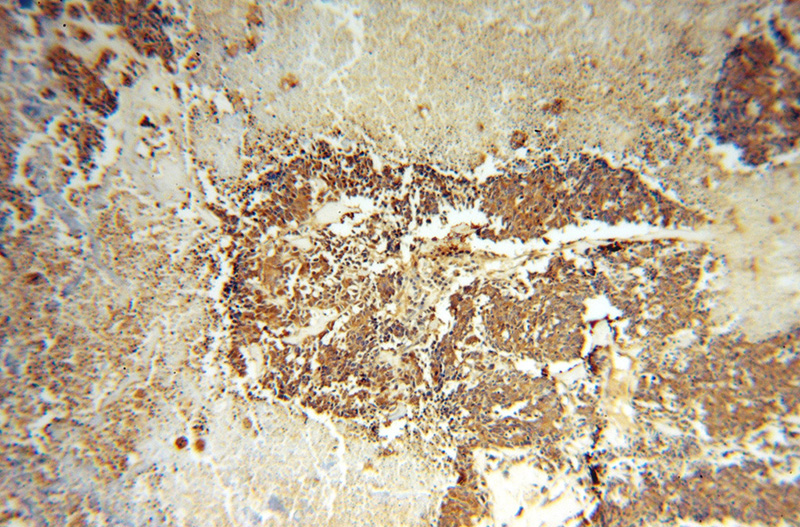 Immunohistochemical of paraffin-embedded human lung cancer using Catalog No:108233(ASNA1 antibody) at dilution of 1:50 (under 10x lens)