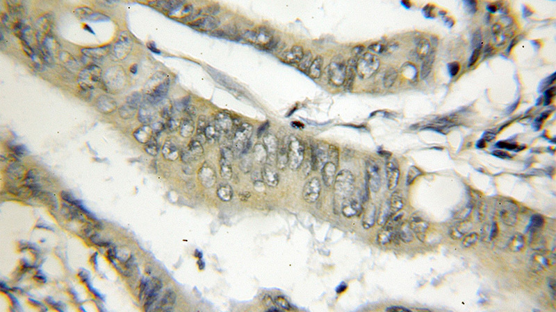 Immunohistochemical of paraffin-embedded human colon cancer using Catalog No:116051(THOP1 antibody) at dilution of 1:50 (under 10x lens)