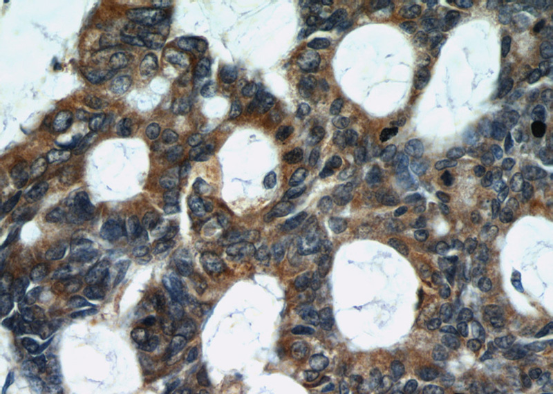Immunohistochemical of paraffin-embedded human colon cancer using Catalog No:108701(C20orf30 antibody) at dilution of 1:50 (under 40x lens)