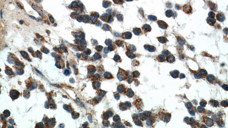 Immunohistochemical of paraffin-embedded human gliomas using Catalog No:111601(IDH1 antibody) at dilution of 1:50 (under 40x lens)