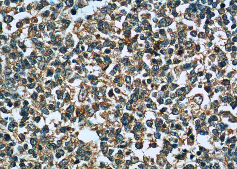 Immunohistochemistry of paraffin-embedded human tonsillitis tissue slide using Catalog No:114343(PVRIG Antibody) at dilution of 1:50 (under 40x lens)