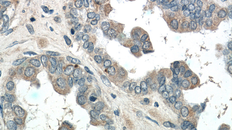 Immunohistochemistry of paraffin-embedded human ovary tumor tissue slide using Catalog No:113869(PIK3R5 Antibody) at dilution of 1:50 (under 40x lens)