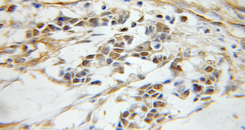 Immunohistochemical of paraffin-embedded human colon cancer using Catalog No:113318(ocT4 antibody) at dilution of 1:50 (under 10x lens)