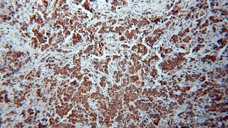 Immunohistochemical of paraffin-embedded human breast cancer using Catalog No:111933(IRS1 antibody) at dilution of 1:100 (under 10x lens)