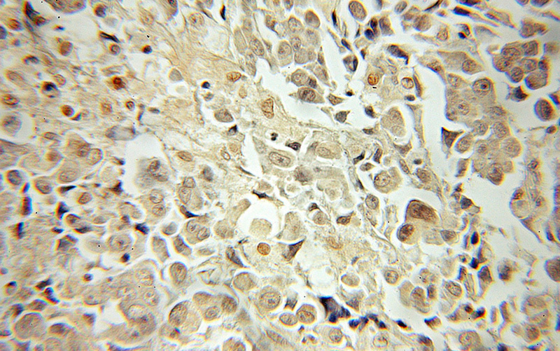 Immunohistochemical of paraffin-embedded human prostate cancer using Catalog No:111891(JNK antibody) at dilution of 1:50 (under 10x lens)