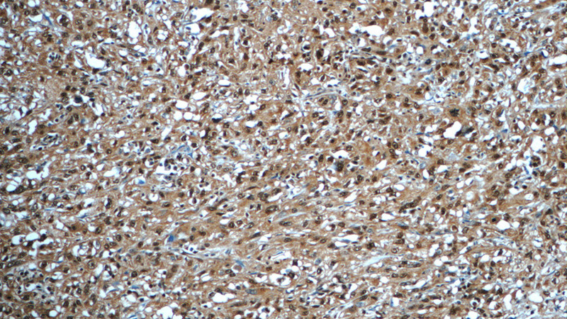 Immunohistochemistry of paraffin-embedded human cervical cancer tissue slide using Catalog No:107567(AKT Antibody) at dilution of 1:50 (under 10x lens)