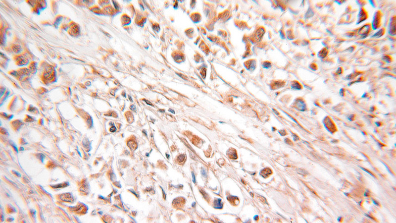 Immunohistochemical of paraffin-embedded human breast cancer using Catalog No:113359(NUDT2 antibody) at dilution of 1:100 (under 25x lens)