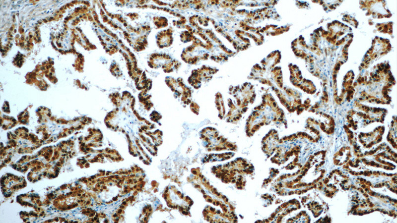 Immunohistochemistry of paraffin-embedded human thyroid cancer tissue slide using Catalog No:114957(S100A13 Antibody) at dilution of 1:50 (under 10x lens)