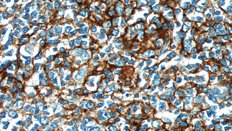 Immunohistochemistry of paraffin-embedded human tonsillitis tissue slide using Catalog No:109010(FCER2,CD23 Antibody) at dilution of 1:50 (under 40x lens)