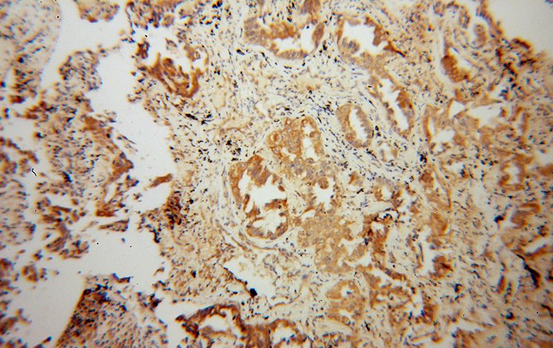 Immunohistochemical of paraffin-embedded human lung cancer using Catalog No:112529(MFN1 antibody) at dilution of 1:100 (under 10x lens)