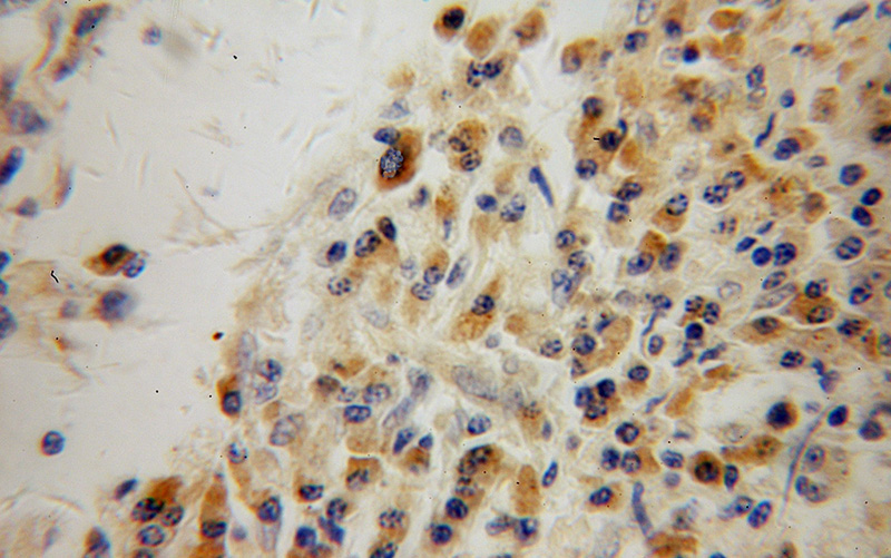 Immunohistochemical of paraffin-embedded human lung cancer using Catalog No:115230(SIK1 antibody) at dilution of 1:100 (under 40x lens)