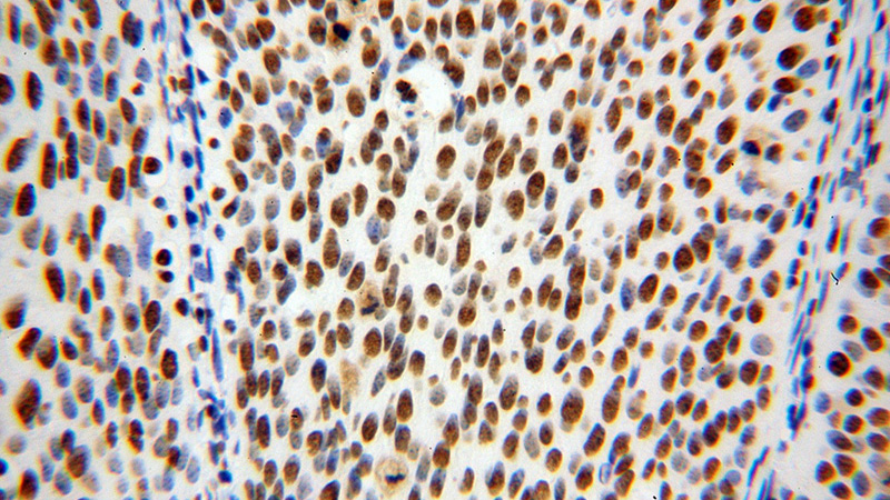 Immunohistochemical of paraffin-embedded human cervical cancer using Catalog No:111504(HNRNPD antibody) at dilution of 1:100 (under 40x lens)