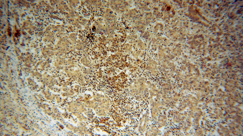 Immunohistochemical of paraffin-embedded human breast cancer using Catalog No:110837(LGALS4,GAL4 antibody) at dilution of 1:50 (under 10x lens)