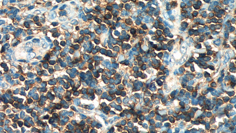 Immunohistochemistry of paraffin-embedded human tonsillitis tissue slide using Catalog No:107130(CD3G Antibody) at dilution of 1:400 (under 40x lens). heat mediated antigen retrieved with Sodium Citrate buffer (pH6).