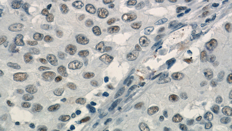 Immunohistochemistry of paraffin-embedded human lung cancer slide using Catalog No:116069(TLE3 Antibody) at dilution of 1:50
