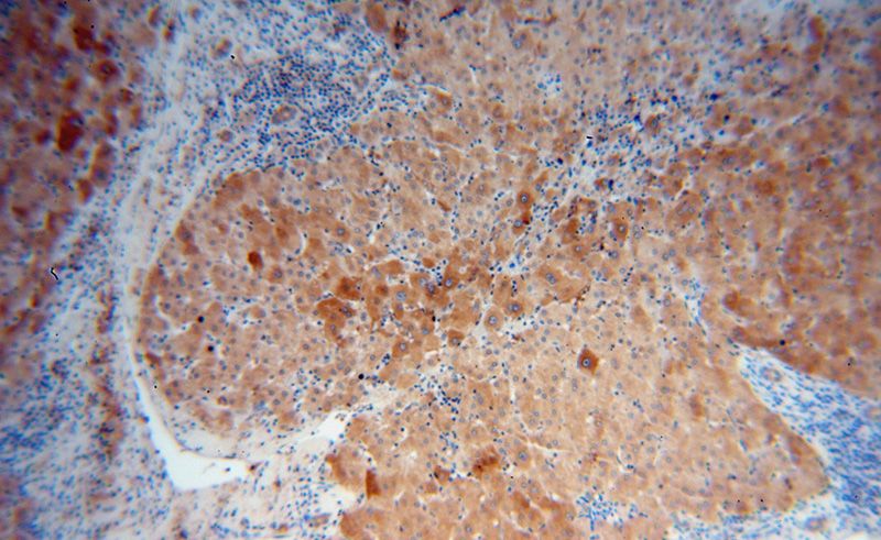 Immunohistochemical of paraffin-embedded human liver cancer using Catalog No:107785(ADSL antibody) at dilution of 1:50 (under 10x lens)