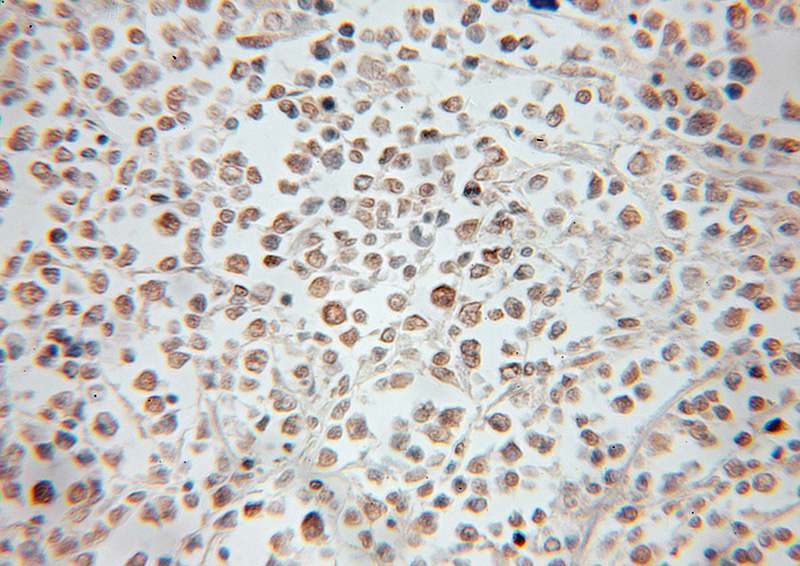 Immunohistochemical of paraffin-embedded human lymphoma using Catalog No:114224(PROX1 antibody) at dilution of 1:50 (under 10x lens)