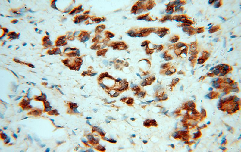Immunohistochemical of paraffin-embedded human gliomas using Catalog No:107914(AGAP2 antibody) at dilution of 1:100 (under 40x lens)