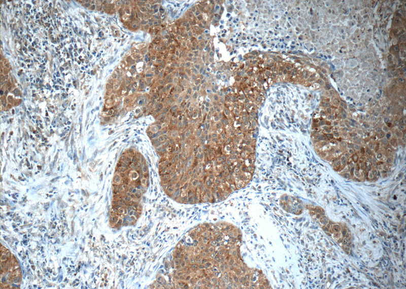 Immunohistochemistry of paraffin-embedded human lung cancer tissue slide using Catalog No:112697(MMP12 Antibody) at dilution of 1:50 (under 10x lens)