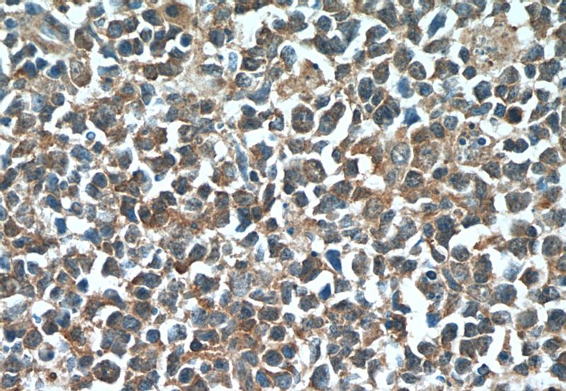 Immunohistochemistry of paraffin-embedded human tonsillitis tissue slide using Catalog No:111839(IRF7 Antibody) at dilution of 1:50 (under 40x lens)