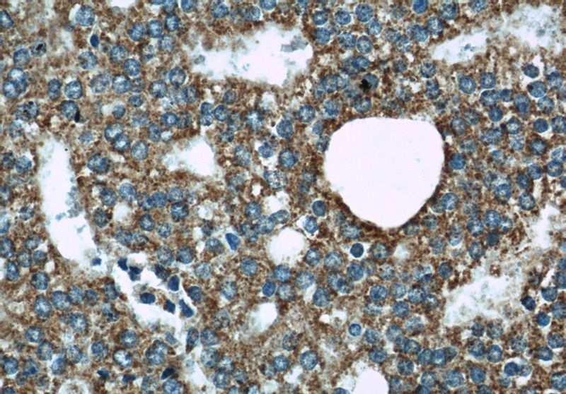 Immunohistochemical of paraffin-embedded human prostate cancer using Catalog No:116971(WSB1 antibody) at dilution of 1:50 (under 40x lens)