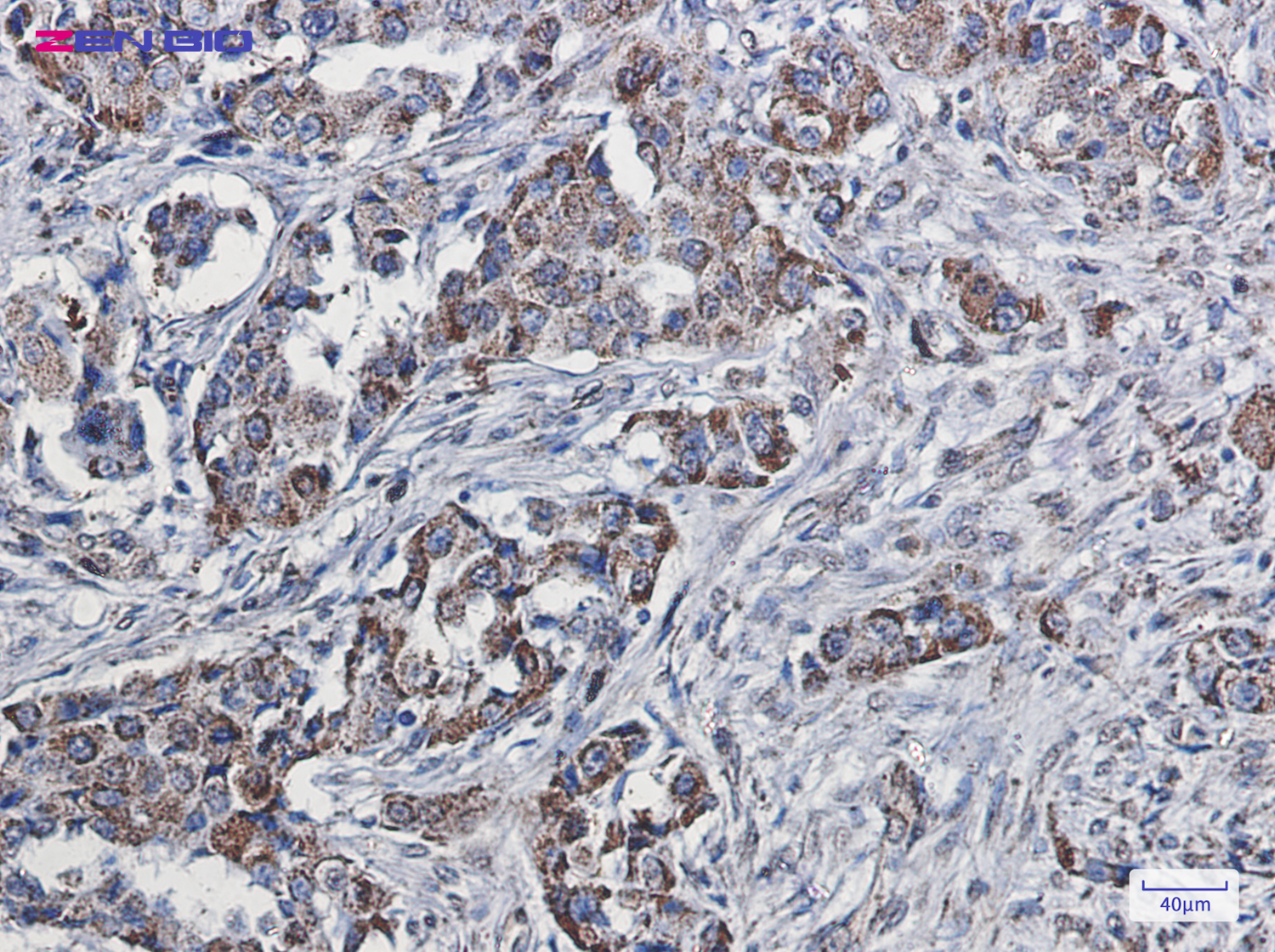 Immunohistochemistry of SEC61A in paraffin-embedded Human lung cancer tissue using SEC61A Rabbit pAb at dilution 1/20