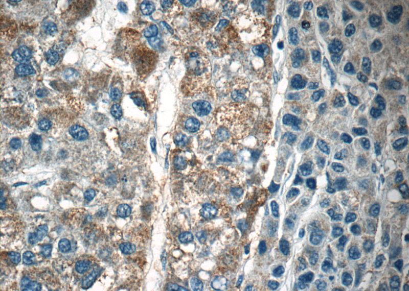 Immunohistochemistry of paraffin-embedded human liver cancer tissue slide using Catalog No:112143(LAPTM4B Antibody) at dilution of 1:50 (under 40x lens)