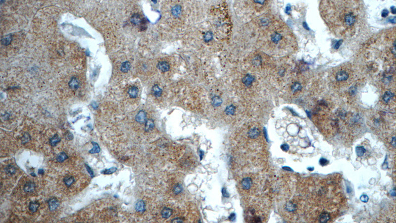 Immunohistochemistry of paraffin-embedded human hepatocirrhosis tissue slide using Catalog No:110657(FGG Antibody) at dilution of 1:50 (under 40x lens)