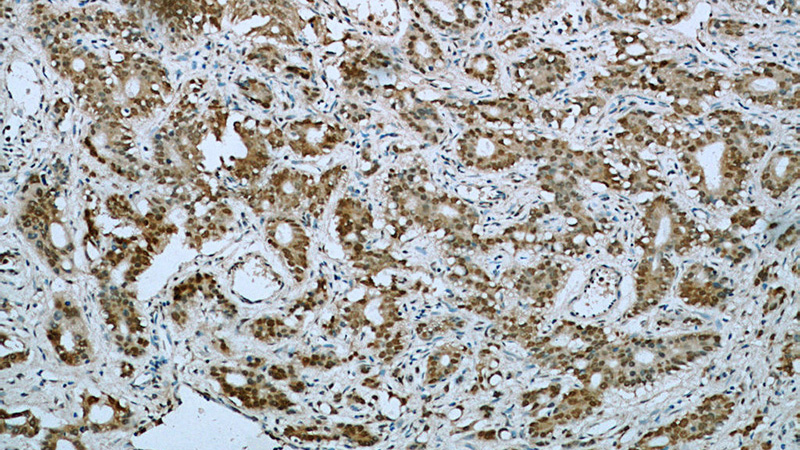 Immunohistochemical of paraffin-embedded human gliomas using Catalog No:110283(ELMOD1 antibody) at dilution of 1:100 (under 10x lens)