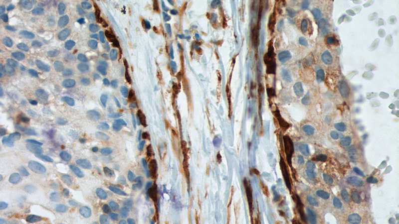 Immunohistochemistry of paraffin-embedded human breast hyperplasia tissue slide using Catalog No:107166(CNN2 Antibody) at dilution of 1:2000 (under 40x lens). heat mediated antigen retrieved with Tris-EDTA buffer(pH9).